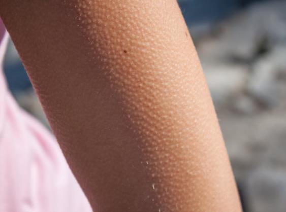 雞皮膚怎么消除 蘆薈膠促進肌膚滋養去除老廢角質