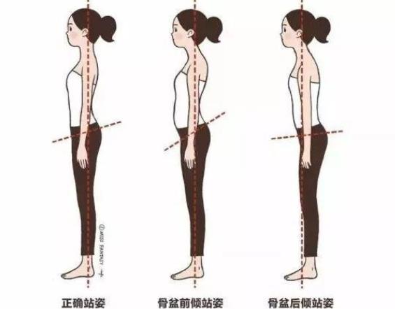 骨盆前傾怎么矯正 腹肌背肌臀部髂腰肌訓練調整走路姿勢