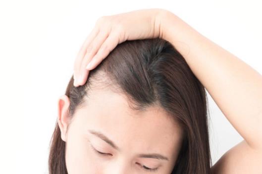 發際線后移怎么辦?如何正確洗頭?