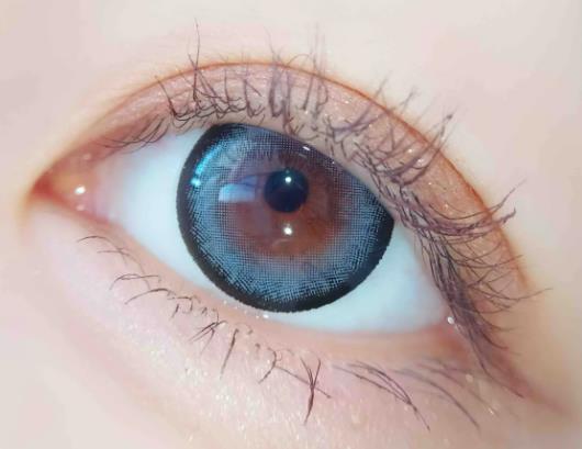 割完雙眼皮后為什么會增生?雙眼皮疤痕軟化后眼睛會自然嗎 割完雙眼皮后為什么會增生?雙眼皮疤痕軟化后眼睛會自然嗎