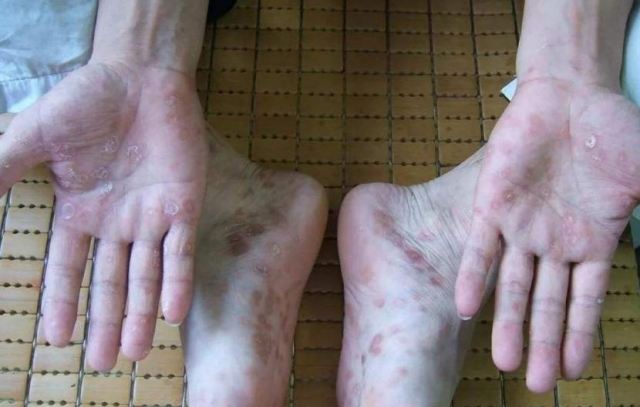 手足癬表現(xiàn)有什么 用醋加鹽泡腳的好處有什么呢 手足癬表現(xiàn)有什么 用醋加鹽泡腳的好處有什么呢