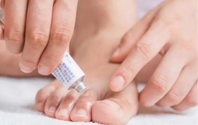 手足癬表現有什么癥狀 手足癬有哪些病癥 手足癬表現有什么癥狀 手足癬有哪些病癥