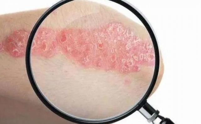 體癬是什么原因引起的 關于體癬能治愈嗎 體癬是什么原因引起的 關于體癬能治愈嗎