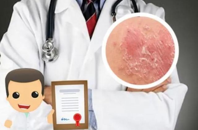 體癬多久可以自愈 體癬能不能治愈 體癬多久可以自愈 體癬能不能治愈