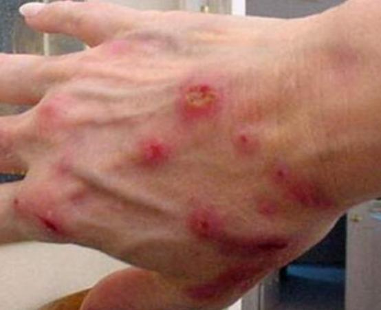 世界十大治不愈的病,慢性疲勞綜合癥、自身免疫失調(diào)都是慢性難治療 世界十大治不愈的病,慢性疲勞綜合癥、自身免疫失調(diào)都是慢性難治療