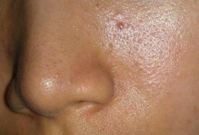 男生臉上出油太多怎么解決 臉出油是什么原因導致的 男生臉上出油太多怎么解決 臉出油是什么原因導致的