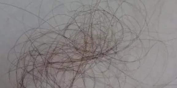 掉頭發嚴重補充什么維生素 掉頭發嚴重是遺傳問題嗎 掉頭發嚴重補充什么維生素 掉頭發嚴重是遺傳問題嗎