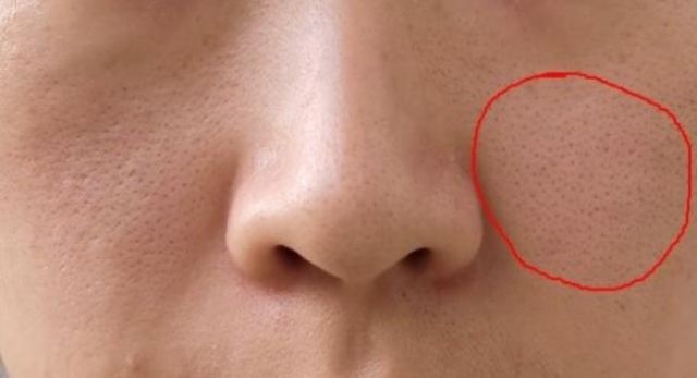 t區(qū)出油毛孔粗大怎么辦 t區(qū)出油臉頰干屬于什么皮膚 t區(qū)出油毛孔粗大怎么辦 t區(qū)出油臉頰干屬于什么皮膚