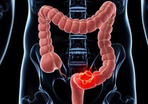 黃連素治療結腸炎嗎?結腸炎多久能恢復 黃連素治療結腸炎嗎?結腸炎多久能恢復