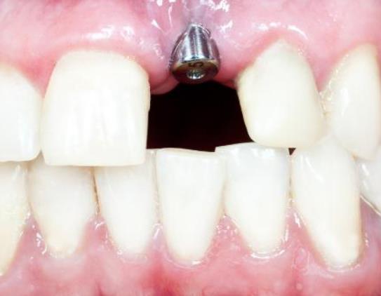 種植牙齒醫保能報銷嗎?種植牙齒能用多少年 種植牙齒醫保能報銷嗎?種植牙齒能用多少年